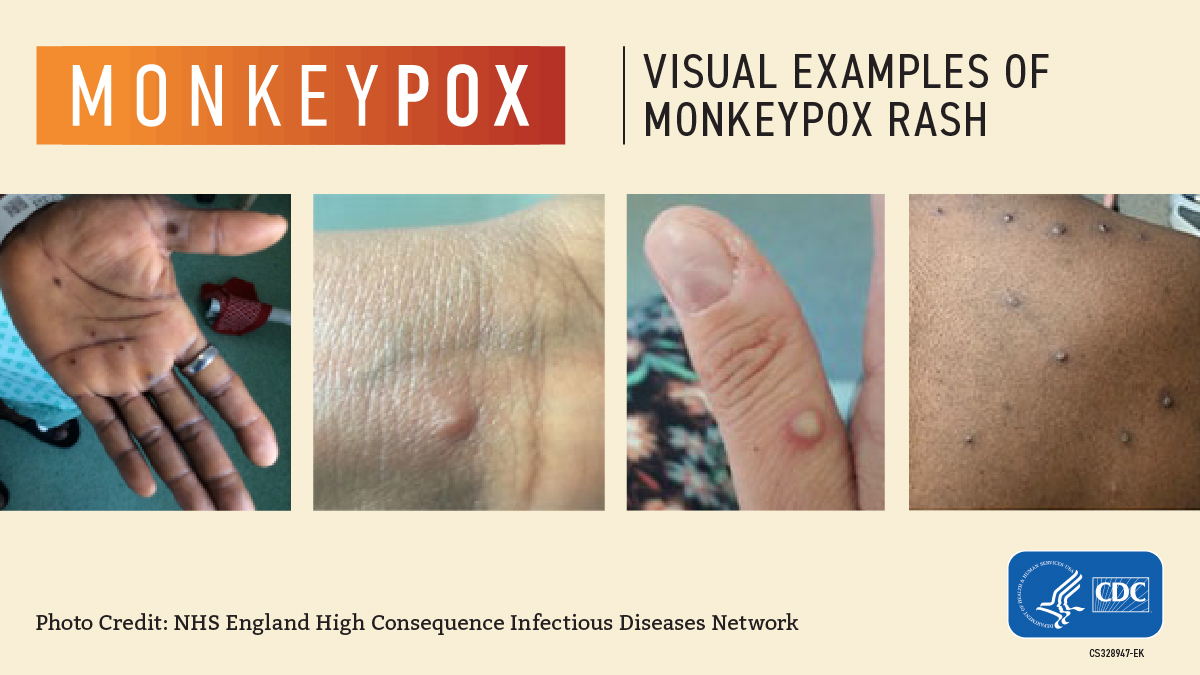 Monkeypox cases in Kentucky remain low, but keep inching up slowly; vaccine is available for those at high risk of getting the disease