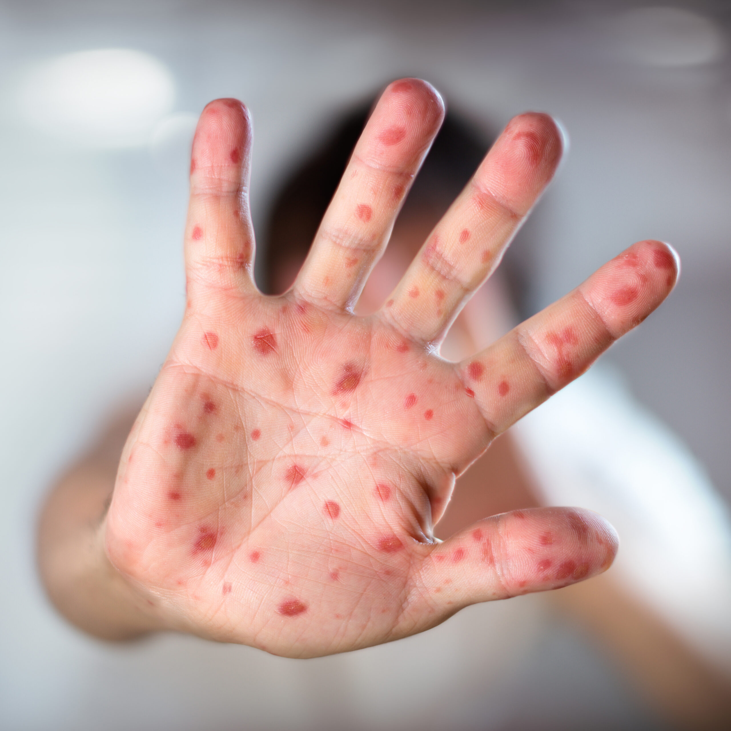 Unvaccinated attendee of big revival has state’s third case of measles in three months