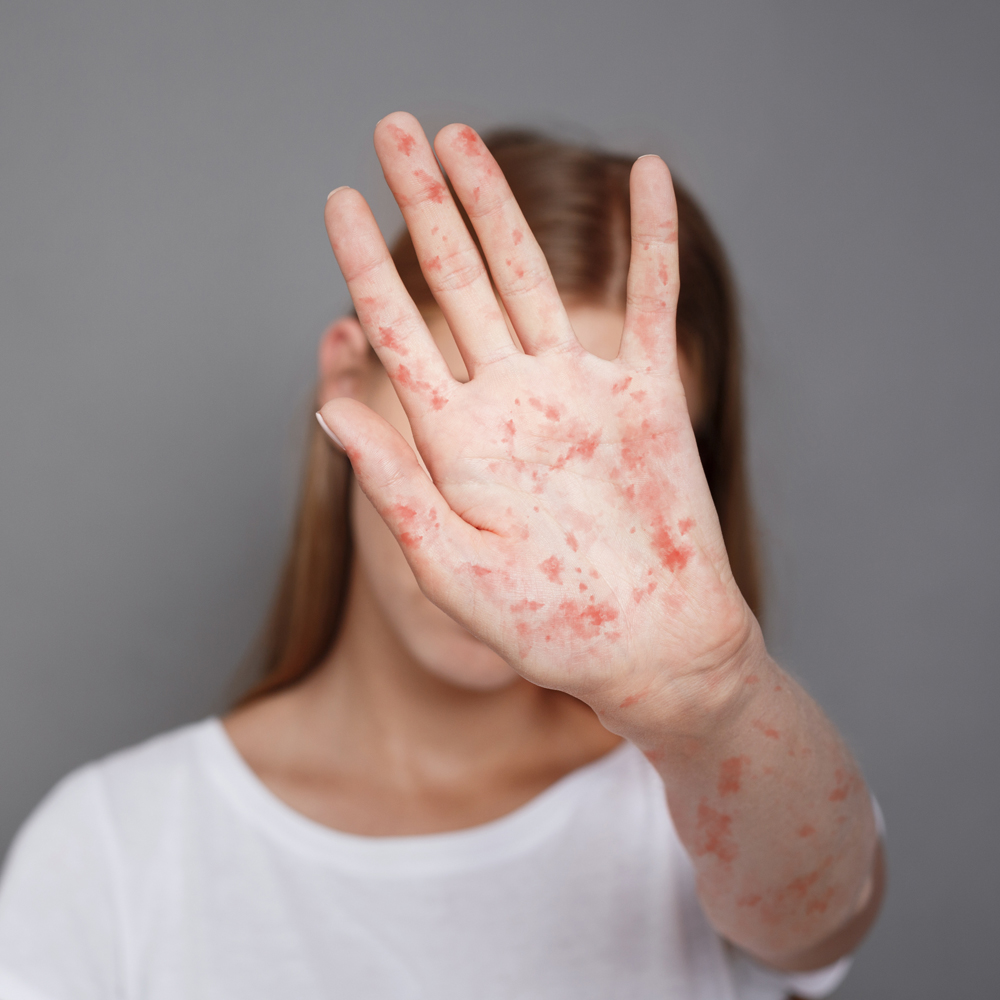 Four new measles cases reported in Kentucky